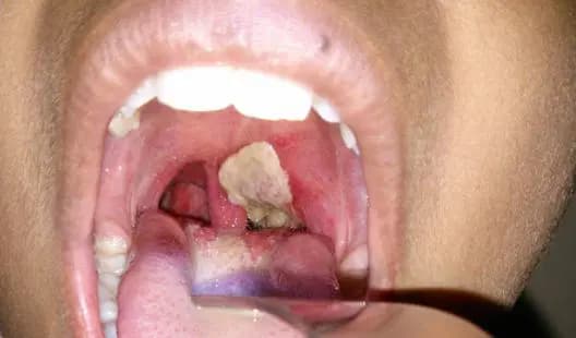 Diphtheria cases recorded in Kano involved 16,000 unvaccinated children — Official