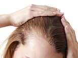 Some weight loss jabs are more likely to make you bald than others, study finds - and it's worse for women
