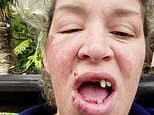 Mother, 48, loses seven teeth when she trips over pothole in the dark as council refuses compensation