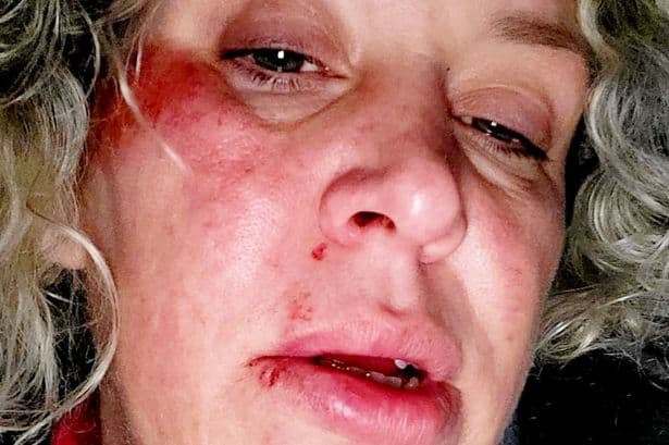 'Pothole left me covered in blood picking up my own teeth and now I want compensation'