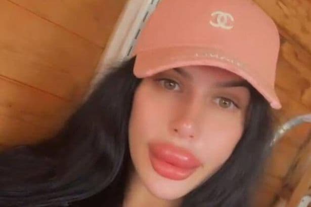 Influencer known for 'Britain's biggest lips' says 'I want to look like I’ve gone too far' after DIY filler