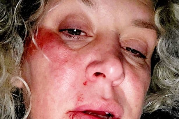 Mum suffers life-changing injuries and unable to work after tripping on a pothole