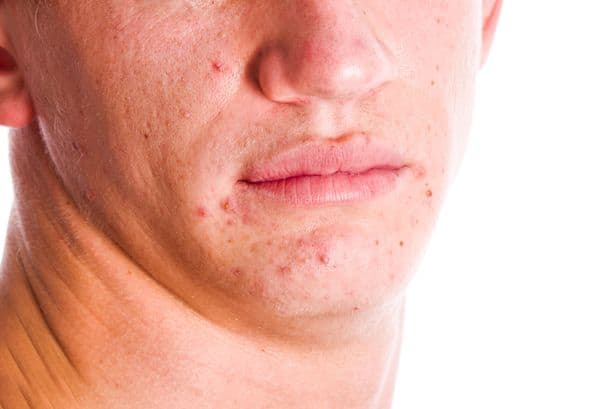 DWP confirms 25 skin conditions that could qualify for £114 weekly PIP payment - including acne