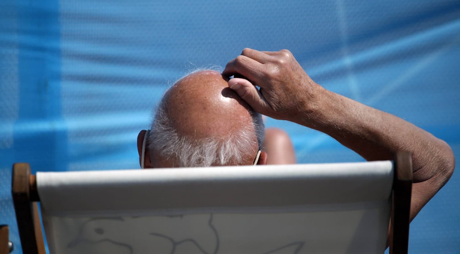 Forget GLP-1 stocks, baldness drugs are Wall Street’s next goldmine